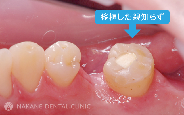 歯の移植｜中根歯科医院